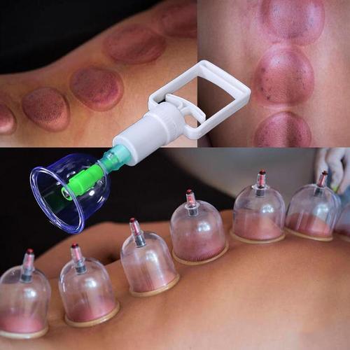 Kit 12 Ventosas + Bomba Ventosa Terapia Massoterapia - Lojas Promorin